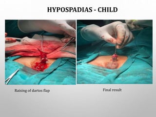 HYPOSPADIAS - CHILD
Raising of dartos flap Final result
 
