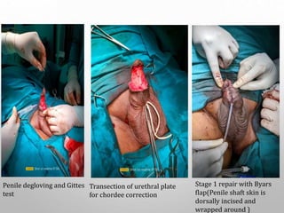 Penile degloving and Gittes
test
Transection of urethral plate
for chordee correction
Stage 1 repair with Byars
flap(Penile shaft skin is
dorsally incised and
wrapped around )
 