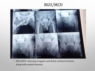 • RGU/MCU- showing irregular and distal urethral stricture
along with meatal stenosis
RGU/MCU
 