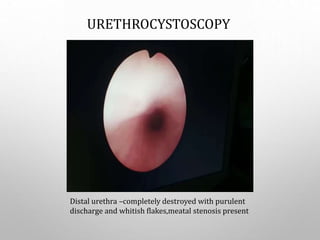 Distal urethra –completely destroyed with purulent
discharge and whitish flakes,meatal stenosis present
URETHROCYSTOSCOPY
 