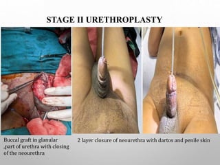 STAGE II URETHROPLASTY
Buccal graft in glanular
,part of urethra with closing
of the neourethra
2 layer closure of neourethra with dartos and penile skin
 