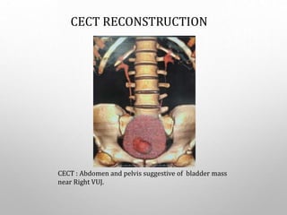CECT RECONSTRUCTION
CECT : Abdomen and pelvis suggestive of bladder mass
near Right VUJ.
 