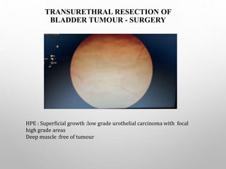TRANSURETHRAL RESECTION OF
BLADDER TUMOUR - SURGERY
HPE : Superficial growth :low grade urothelial carcinoma with focal
high grade areas
Deep muscle :free of tumour
 
