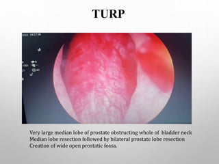 TURP
Very large median lobe of prostate obstructing whole of bladder neck
Median lobe resection followed by bilateral prostate lobe resection
Creation of wide open prostatic fossa.
 