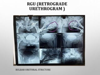 RGU (RETROGRADE
URETHROGRAM )
BULBAR URETHRAL STRICTURE
 