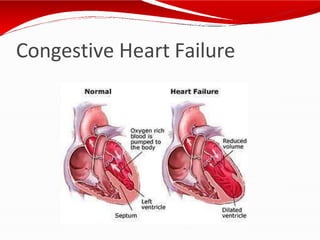 Congestive Heart Failure
 