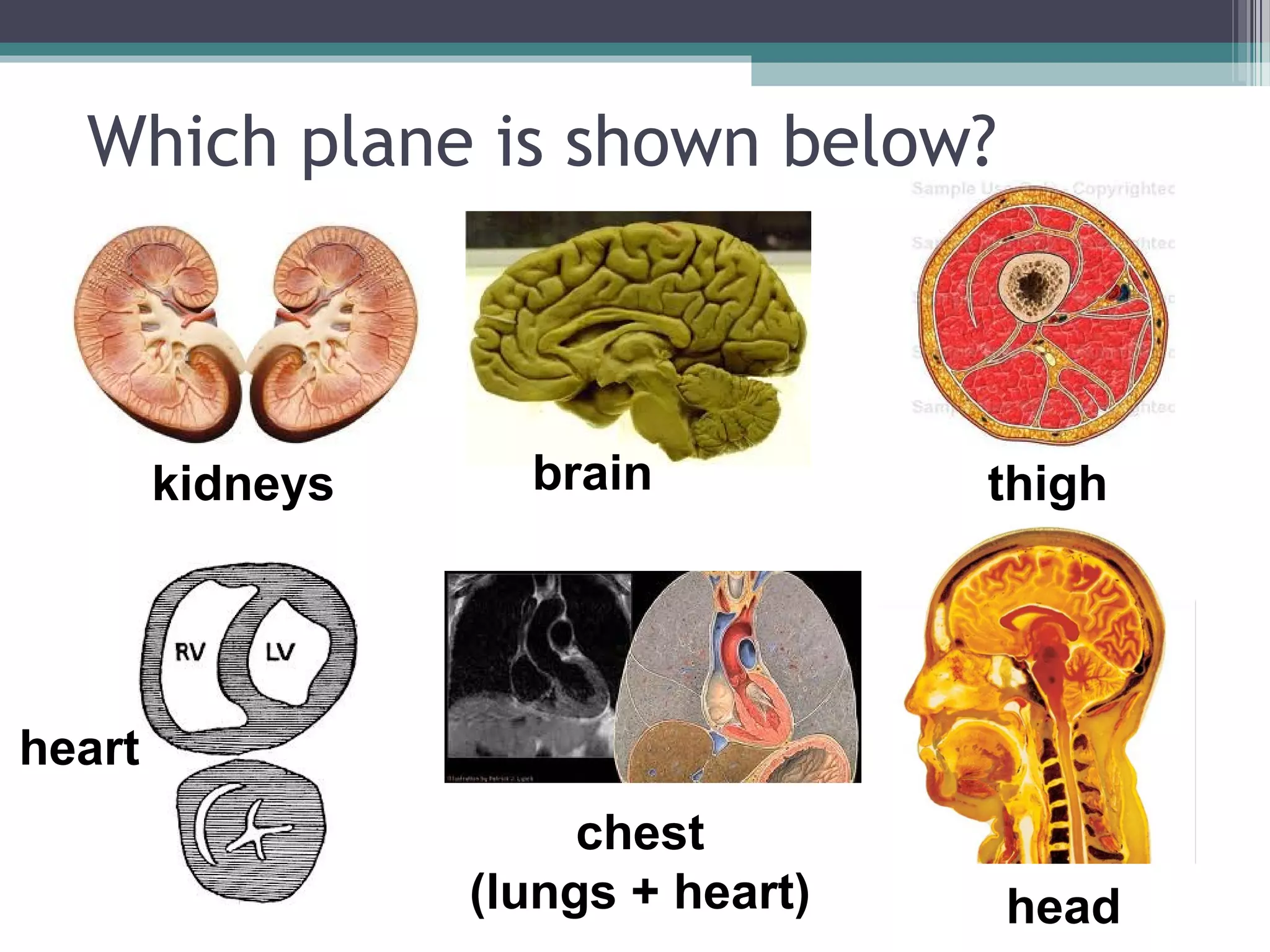 Which plane is shown below? 
kidneys brain thigh 
heart 
head 
chest 
(lungs + heart) 
 