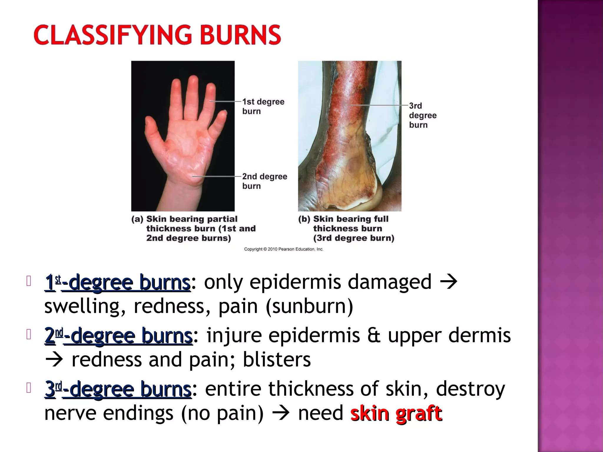  11stst
-degree burns-degree burns: only epidermis damaged 
swelling, redness, pain (sunburn)
 22ndnd
-degree burns-degree burns: injure epidermis & upper dermis
 redness and pain; blisters
 33rdrd
-degree burns-degree burns: entire thickness of skin, destroy
nerve endings (no pain)  need skin graftskin graft
 
