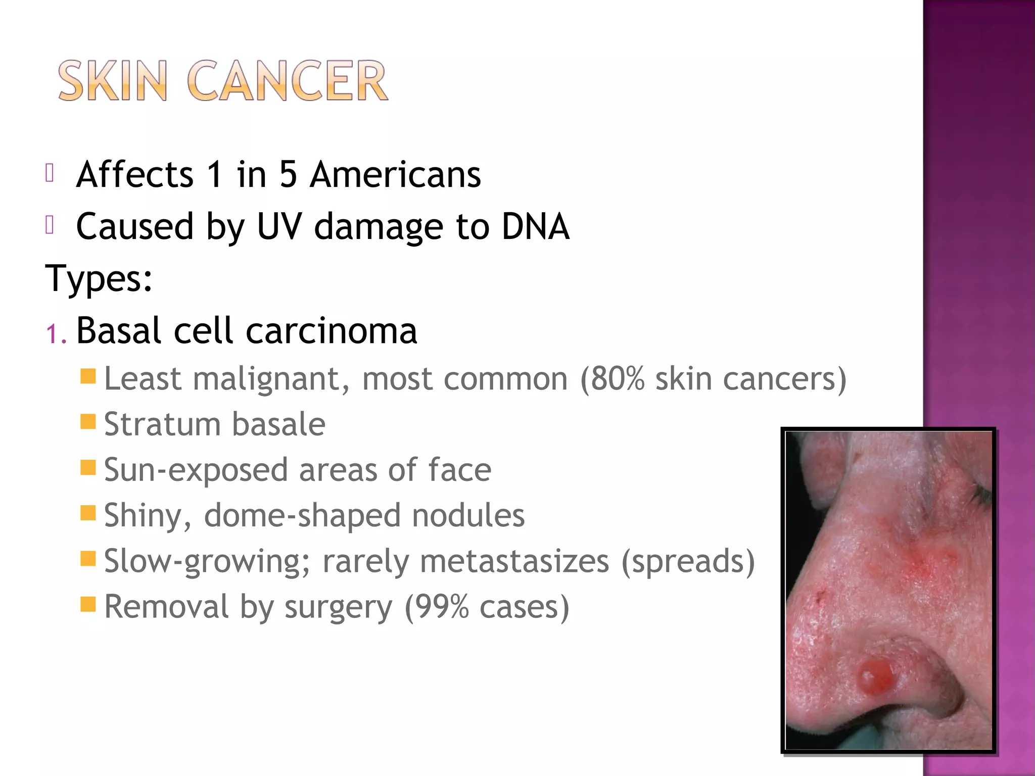  Affects 1 in 5 Americans
 Caused by UV damage to DNA
Types:
1. Basal cell carcinoma
 Least malignant, most common (80% skin cancers)
 Stratum basale
 Sun-exposed areas of face
 Shiny, dome-shaped nodules
 Slow-growing; rarely metastasizes (spreads)
 Removal by surgery (99% cases)
 