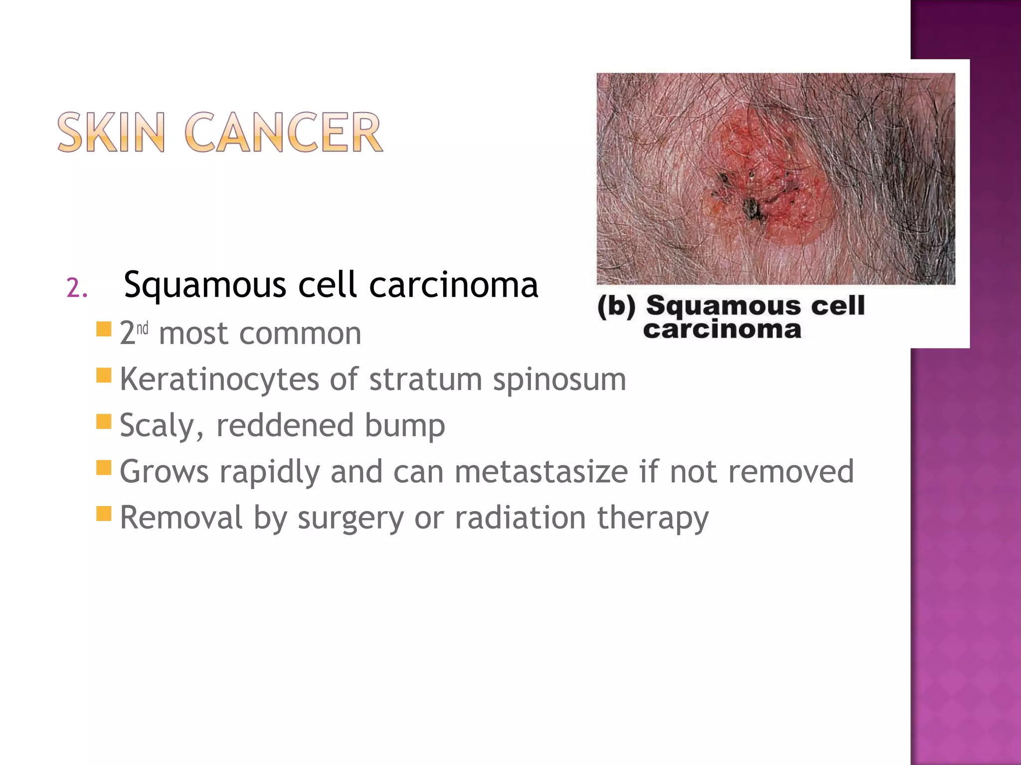 2. Squamous cell carcinoma
 2nd
most common
 Keratinocytes of stratum spinosum
 Scaly, reddened bump
 Grows rapidly and can metastasize if not removed
 Removal by surgery or radiation therapy
 