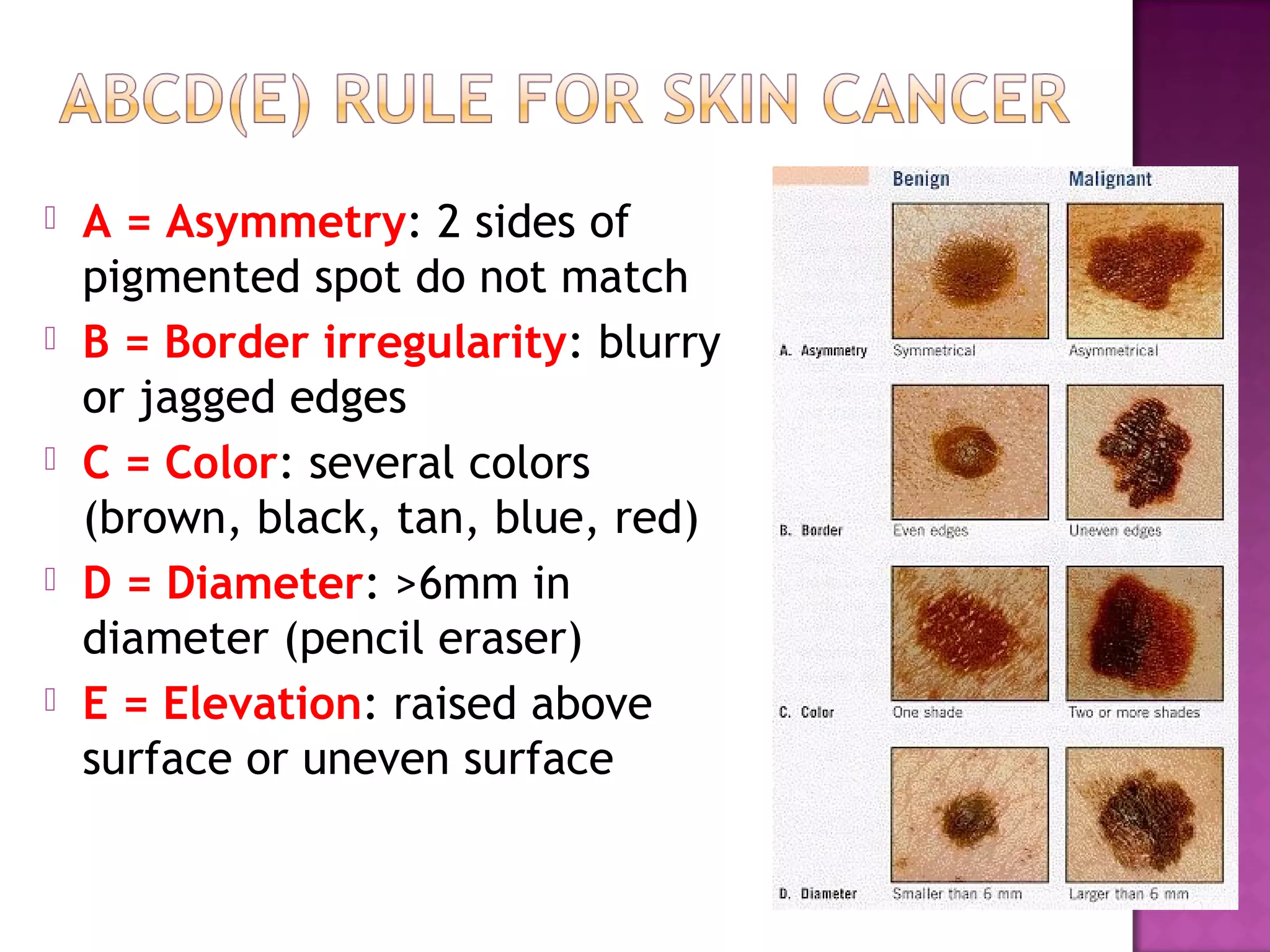  A = Asymmetry: 2 sides of
pigmented spot do not match
 B = Border irregularity: blurry
or jagged edges
 C = Color: several colors
(brown, black, tan, blue, red)
 D = Diameter: >6mm in
diameter (pencil eraser)
 E = Elevation: raised above
surface or uneven surface
 