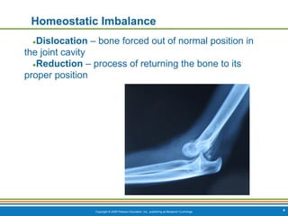 Copyright © 2009 Pearson Education, Inc., publishing as Benjamin Cummings
Homeostatic Imbalance
●Dislocation – bone forced out of normal position in
the joint cavity
●Reduction – process of returning the bone to its
proper position
*
 