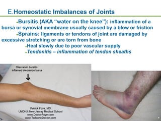 Copyright © 2009 Pearson Education, Inc., publishing as Benjamin Cummings *
E.Homeostatic Imbalances of Joints
●Bursitis (AKA “water on the knee”): inflammation of a
bursa or synovial membrane usually caused by a blow or friction
●Sprains: ligaments or tendons of joint are damaged by
excessive stretching or are torn from bone
●Heal slowly due to poor vascular supply
●Tendonitis – inflammation of tendon sheaths
 