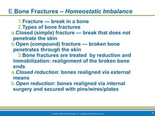 Copyright © 2009 Pearson Education, Inc., publishing as Benjamin Cummings *
E.Bone Fractures – Homeostatic Imbalance
1.Fracture — break in a bone
2.Types of bone fractures
a.Closed (simple) fracture — break that does not
penetrate the skin
b.Open (compound) fracture — broken bone
penetrates through the skin
3.Bone fractures are treated by reduction and
immobilization: realignment of the broken bone
ends
a.Closed reduction: bones realigned via external
means
b.Open reduction: bones realigned via internal
surgery and secured with pins/wires/plates
 