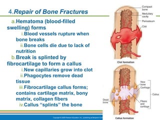 Copyright © 2009 Pearson Education, Inc., publishing as Benjamin Cummings *
4.Repair of Bone Fractures
a.Hematoma (blood-filled
swelling) forms
i.Blood vessels rupture when
bone breaks
ii.Bone cells die due to lack of
nutrition
b.Break is splinted by
fibrocartilage to form a callus
i.New capillaries grow into clot
ii.Phagocytes remove dead
tissue
iii.Fibrocartilage callus forms;
contains cartilage matrix, bony
matrix, collagen fibers
iv.Callus “splints” the bone
 