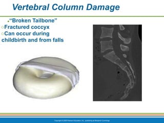 Copyright © 2009 Pearson Education, Inc., publishing as Benjamin Cummings
Vertebral Column Damage
●“Broken Tailbone”
○Fractured coccyx
○Can occur during
childbirth and from falls
 