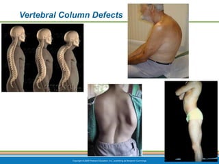Copyright © 2009 Pearson Education, Inc., publishing as Benjamin Cummings
Vertebral Column Defects
 