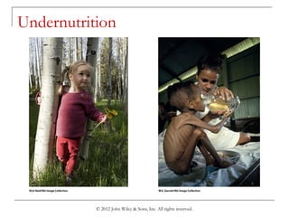 © 2012 John Wiley & Sons, Inc. All rights reserved.
Undernutrition
 