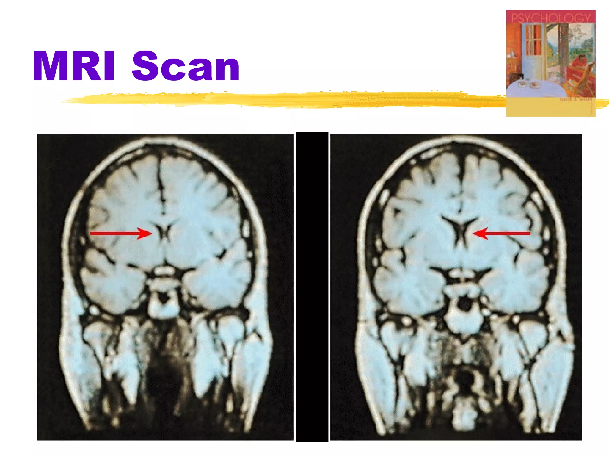 MRI Scan
 