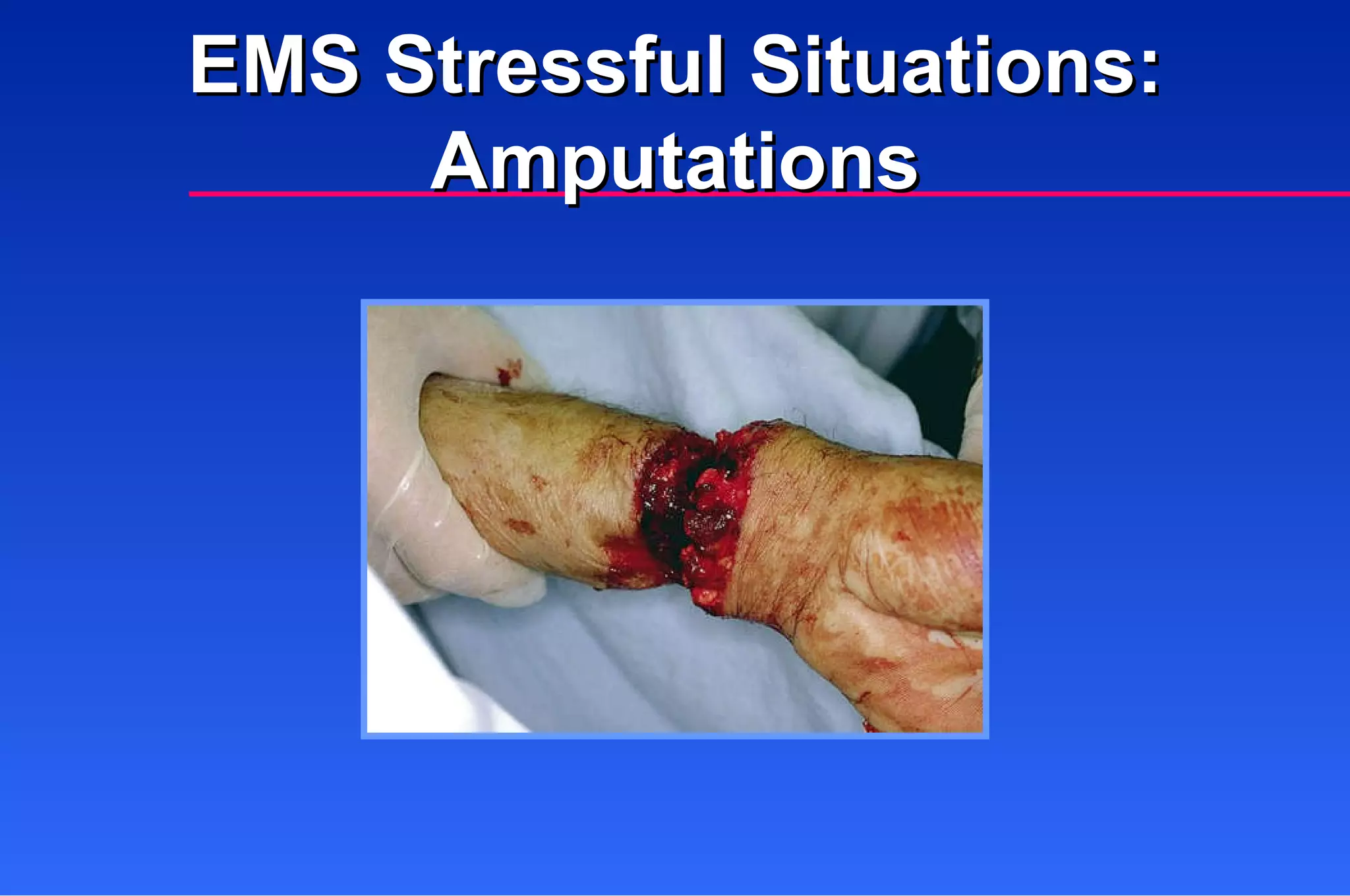 EMS Stressful Situations: Amputations 