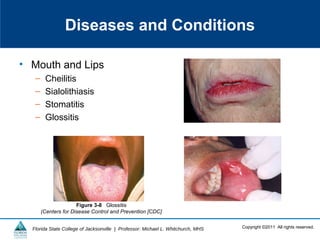 Copyright ©2011 All rights reserved.Florida State College of Jacksonville | Professor: Michael L. Whitchurch, MHS
Diseases and Conditions
• Mouth and Lips
– Cheilitis
– Sialolithiasis
– Stomatitis
– Glossitis
Figure 3-8 Glossitis
(Centers for Disease Control and Prevention [CDC]
 