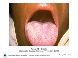 Copyright ©2011 All rights reserved.Florida State College of Jacksonville | Professor: Michael L. Whitchurch, MHS
Figure 3-8 Glossitis
(Centers for Disease Control and Prevention [CDC])
 