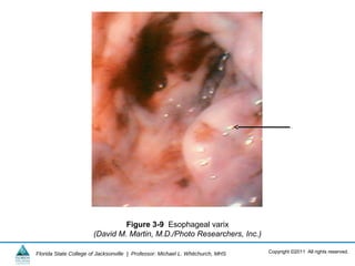 Copyright ©2011 All rights reserved.Florida State College of Jacksonville | Professor: Michael L. Whitchurch, MHS
Figure 3-9 Esophageal varix
(David M. Martin, M.D./Photo Researchers, Inc.)
 