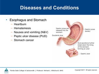Copyright ©2011 All rights reserved.Florida State College of Jacksonville | Professor: Michael L. Whitchurch, MHS
Diseases and Conditions
• Esophagus and Stomach
– Heartburn
– Hematemesis
– Nausea and vomiting (N&V)
– Peptic ulcer disease (PUD)
– Stomach cancer
 