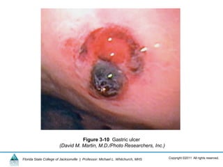 Copyright ©2011 All rights reserved.Florida State College of Jacksonville | Professor: Michael L. Whitchurch, MHS
Figure 3-10 Gastric ulcer
(David M. Martin, M.D./Photo Researchers, Inc.)
 