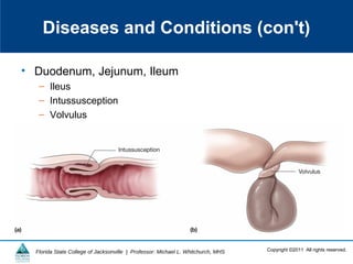 Copyright ©2011 All rights reserved.Florida State College of Jacksonville | Professor: Michael L. Whitchurch, MHS
Diseases and Conditions (con't)
• Duodenum, Jejunum, Ileum
– Ileus
– Intussusception
– Volvulus
 