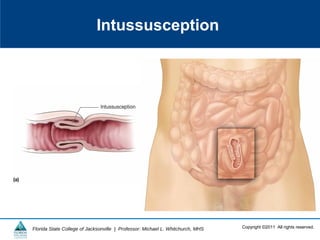 Copyright ©2011 All rights reserved.Florida State College of Jacksonville | Professor: Michael L. Whitchurch, MHS
Intussusception
 