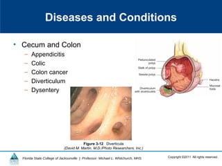 Copyright ©2011 All rights reserved.Florida State College of Jacksonville | Professor: Michael L. Whitchurch, MHS
Diseases and Conditions
• Cecum and Colon
– Appendicitis
– Colic
– Colon cancer
– Diverticulum
– Dysentery
Figure 3-12 Diverticula
(David M. Martin, M.D./Photo Researchers, Inc.)
 