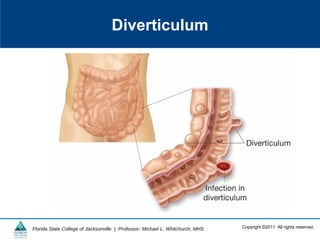 Copyright ©2011 All rights reserved.Florida State College of Jacksonville | Professor: Michael L. Whitchurch, MHS
Diverticulum
 