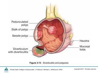Copyright ©2011 All rights reserved.Florida State College of Jacksonville | Professor: Michael L. Whitchurch, MHS
Figure 3-13 Diverticulitis and polyposis
 