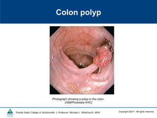 Copyright ©2011 All rights reserved.Florida State College of Jacksonville | Professor: Michael L. Whitchurch, MHS
Colon polyp
Photograph showing a polyp in the colon.
(ISM/Phototake NYC)
 