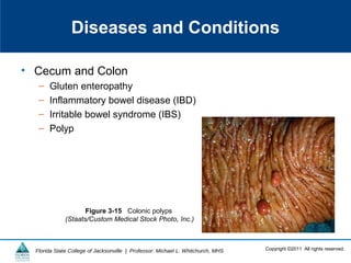 Copyright ©2011 All rights reserved.Florida State College of Jacksonville | Professor: Michael L. Whitchurch, MHS
Diseases and Conditions
• Cecum and Colon
– Gluten enteropathy
– Inflammatory bowel disease (IBD)
– Irritable bowel syndrome (IBS)
– Polyp
Figure 3-15 Colonic polyps
(Staats/Custom Medical Stock Photo, Inc.)
 