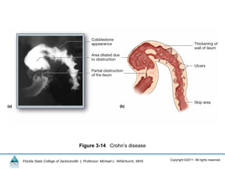 Copyright ©2011 All rights reserved.Florida State College of Jacksonville | Professor: Michael L. Whitchurch, MHS
Figure 3-14 Crohn’s disease
 