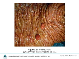 Copyright ©2011 All rights reserved.Florida State College of Jacksonville | Professor: Michael L. Whitchurch, MHS
Figure 3-15 Colonic polyps
(Staats/Custom Medical Stock Photo, Inc.)
 
