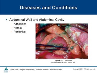 Copyright ©2011 All rights reserved.Florida State College of Jacksonville | Professor: Michael L. Whitchurch, MHS
Diseases and Conditions
• Abdominal Wall and Abdominal Cavity
– Adhesions
– Hernia
– Peritonitis
Figure 3-17 Peritonitis
(Custom Medical Stock Photo, Inc.)
 