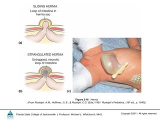 Copyright ©2011 All rights reserved.Florida State College of Jacksonville | Professor: Michael L. Whitchurch, MHS
Figure 3-16 Hernia
(From Rudolph, A.M., Hoffman, J.I.E., & Rudolph, C.D. (Eds.) 1991. Rudolph’s Pediatrics. (19th ed., p. 1040))
 