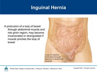 Copyright ©2011 All rights reserved.Florida State College of Jacksonville | Professor: Michael L. Whitchurch, MHS
Inguinal Hernia
A protrusion of a loop of bowel
through abdominal muscle and
into groin region; may become
incarcerated or strangulated if
muscle pinches the loop of
bowel
 