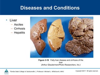 Copyright ©2011 All rights reserved.Florida State College of Jacksonville | Professor: Michael L. Whitchurch, MHS
Diseases and Conditions
• Liver
– Ascites
– Cirrhosis
– Hepatitis
Figure 3-18 Fatty liver disease and cirrhosis of the
liver
(Arthur Glauberman/Photo Researchers, Inc.)
 