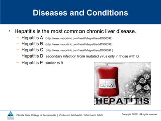 Copyright ©2011 All rights reserved.Florida State College of Jacksonville | Professor: Michael L. Whitchurch, MHS
Diseases and Conditions
• Hepatitis is the most common chronic liver disease.
– Hepatitis A (http://www.mayoclinic.com/health/hepatitis-a/DS00397)
– Hepatitis B (http://www.mayoclinic.com/health/hepatitis-b/DS00398)
– Hepatitis C (http://www.mayoclinic.com/health/hepatitis-c/DS00097 )
– Hepatitis D secondary infection from mutated virus only in those with B
– Hepatitis E similar to B
 