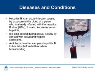 Copyright ©2011 All rights reserved.Florida State College of Jacksonville | Professor: Michael L. Whitchurch, MHS
• Hepatitis B is an acute infection caused
by exposure to the blood of a person
who is already infected with the hepatitis
B virus (HBV); it is also known as serum
hepatitis.
• It is also spread during sexual activity by
contact with saliva and vaginal
secretions.
• An infected mother can pass hepatitis B
to her fetus before birth or when
breastfeeding.
Diseases and Conditions
 
