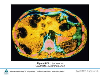 Copyright ©2011 All rights reserved.Florida State College of Jacksonville | Professor: Michael L. Whitchurch, MHS
Figure 3-21 Liver cancer
(Gca/Photo Researchers, Inc.)
 