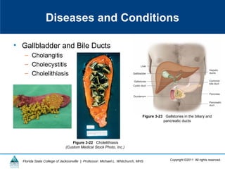 Copyright ©2011 All rights reserved.Florida State College of Jacksonville | Professor: Michael L. Whitchurch, MHS
Diseases and Conditions
• Gallbladder and Bile Ducts
– Cholangitis
– Cholecystitis
– Cholelithiasis
Figure 3-22 Cholelithiasis
(Custom Medical Stock Photo, Inc.)
Figure 3-23 Gallstones in the biliary and
pancreatic ducts
 