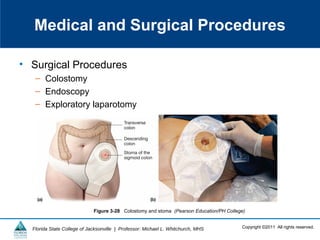 Copyright ©2011 All rights reserved.Florida State College of Jacksonville | Professor: Michael L. Whitchurch, MHS
Medical and Surgical Procedures
• Surgical Procedures
– Colostomy
– Endoscopy
– Exploratory laparotomy
Figure 3-28 Colostomy and stoma (Pearson Education/PH College)
 