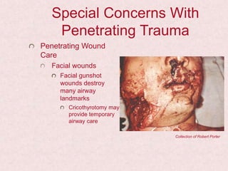 Special Concerns With
Penetrating Trauma
Penetrating Wound
Care
Facial wounds
Facial gunshot
wounds destroy
many airway
landmarks
Cricothyrotomy may
provide temporary
airway care
Collection of Robert Porter
 
