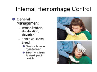 Internal Hemorrhage Control
General
Management
– Immobilization,
stabilization,
elevation
– Epistaxis: Nose
Bleed
Causes: trauma,
hypertension
Treatment: lean
forward, pinch
nostrils
 