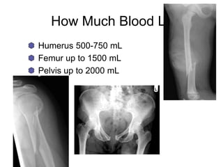 How Much Blood Loss?
Humerus 500-750 mL
Femur up to 1500 mL
Pelvis up to 2000 mL
 